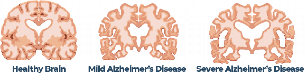 Progression Of Alzheimers Disease